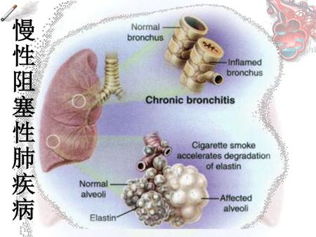 慢 性 阻 塞 肺 疾 病.