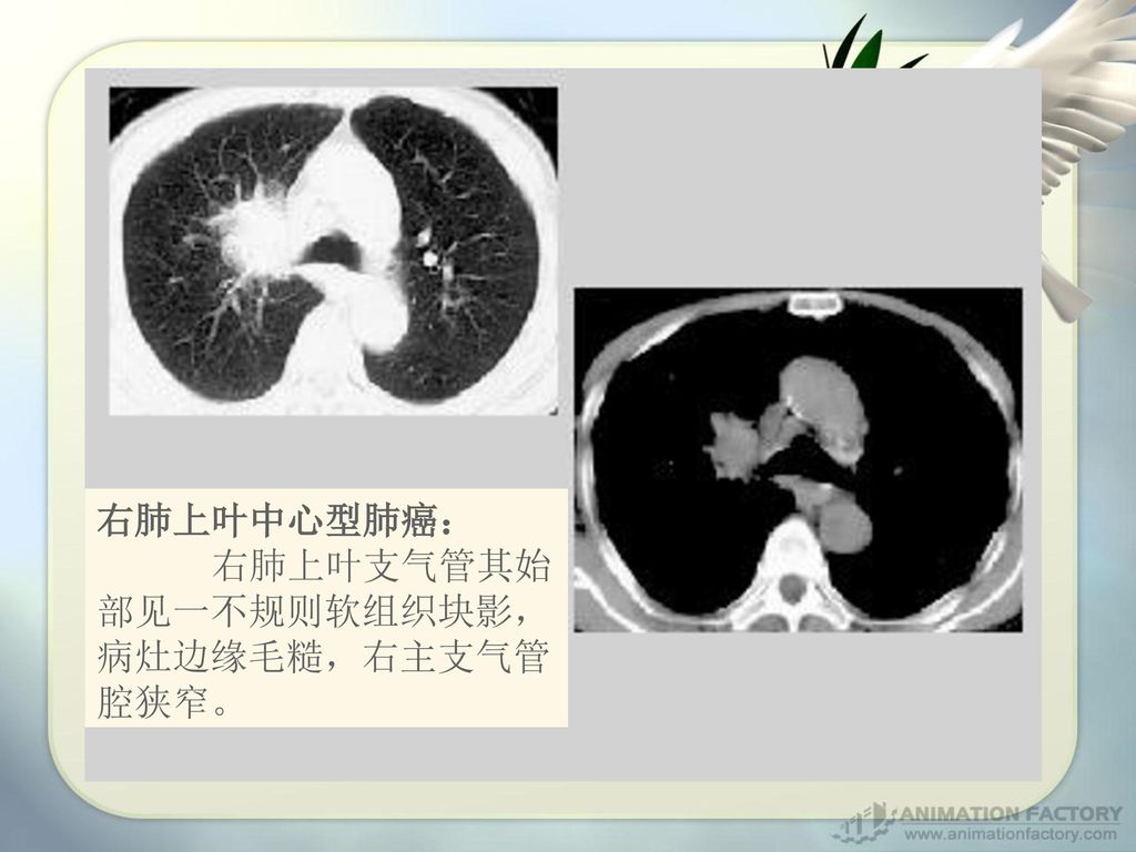 右肺上叶中心型肺癌： 右肺上叶支气管其始部见一不规则软组织块影，病灶边缘毛糙，右主支气管腔狭窄。