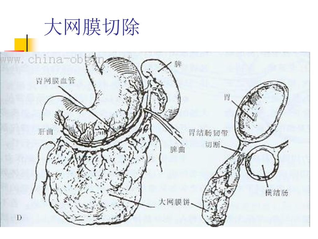 卵巢癌大网膜切除图解图片