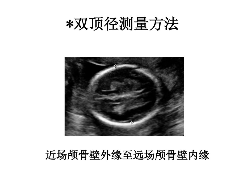 胎儿透明隔腔超声检查专家共识|胼胝体|超声|胎儿|检查|脑室|畸形|-健康界