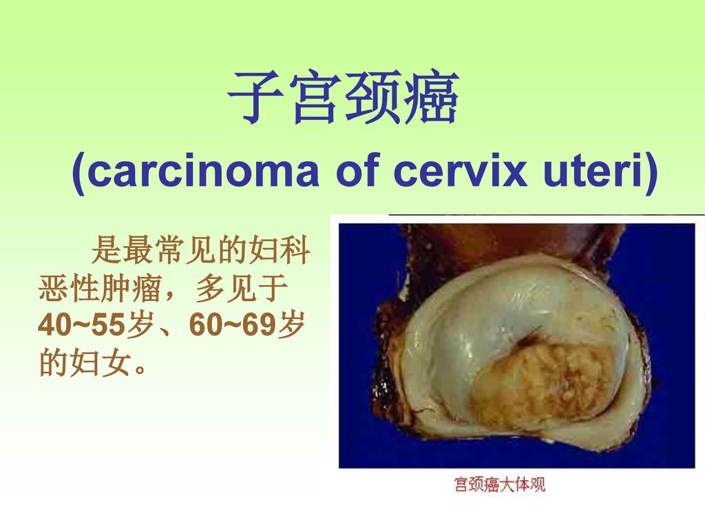子宫颈癌 (carcinoma of cervix uteri) 是最常见的妇科恶性肿瘤，多见于40~55岁、60~69岁的妇女。