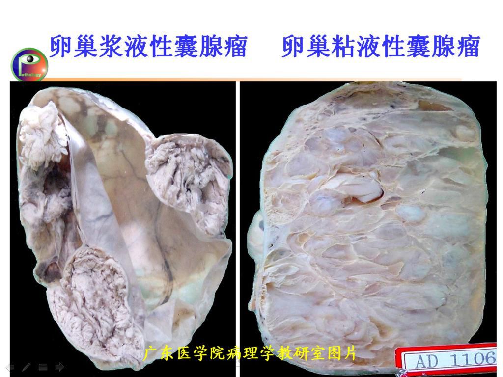 卵巢浆液性囊腺瘤 卵巢粘液性囊腺瘤