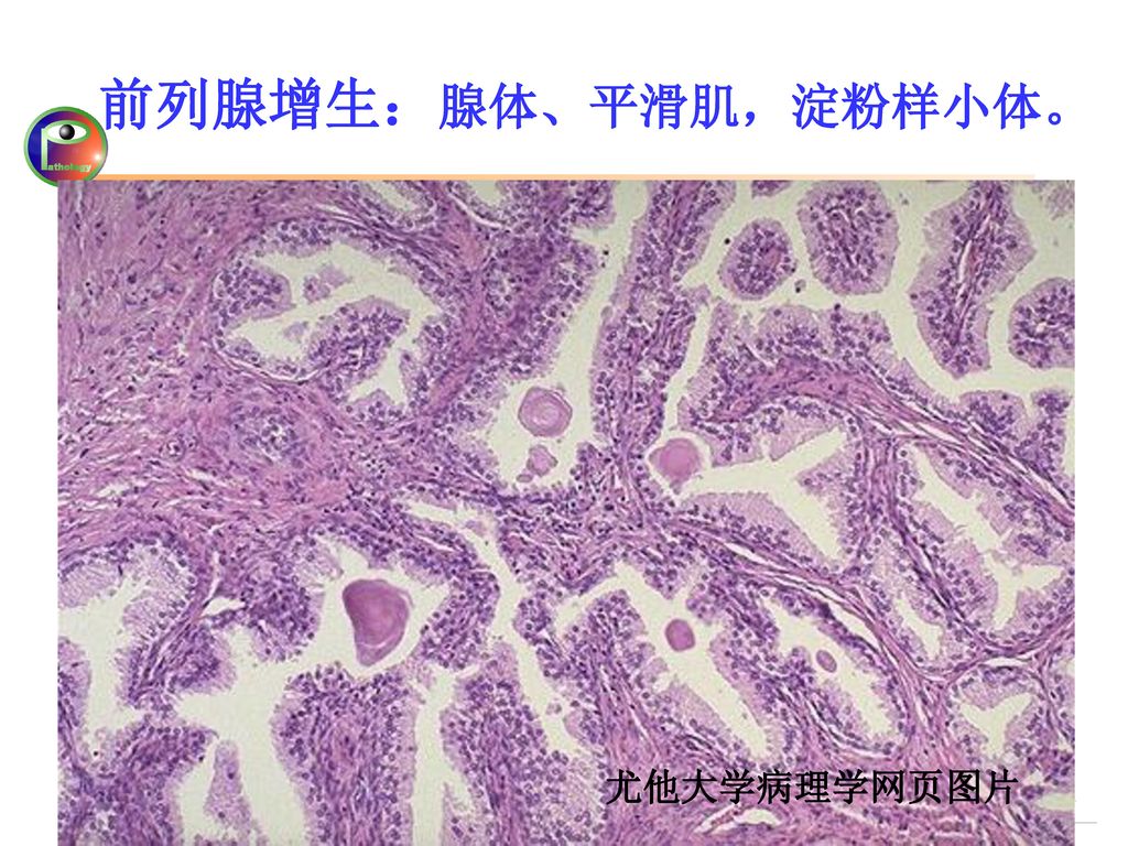 前列腺增生：腺体、平滑肌，淀粉样小体。 尤他大学病理学网页图片