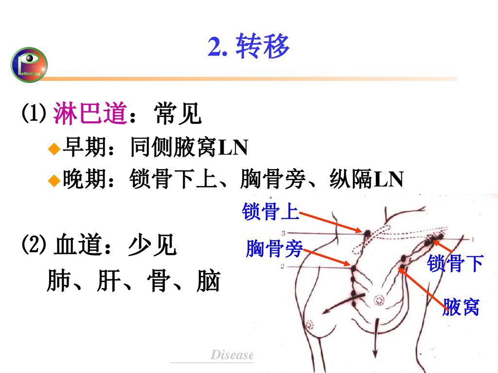 2. 转移 ⑴ 淋巴道：常见 ⑵ 血道：少见 肺、肝、骨、脑 早期：同侧腋窝LN 晚期：锁骨下上、胸骨旁、纵隔LN 锁骨上 胸骨旁 锁骨下