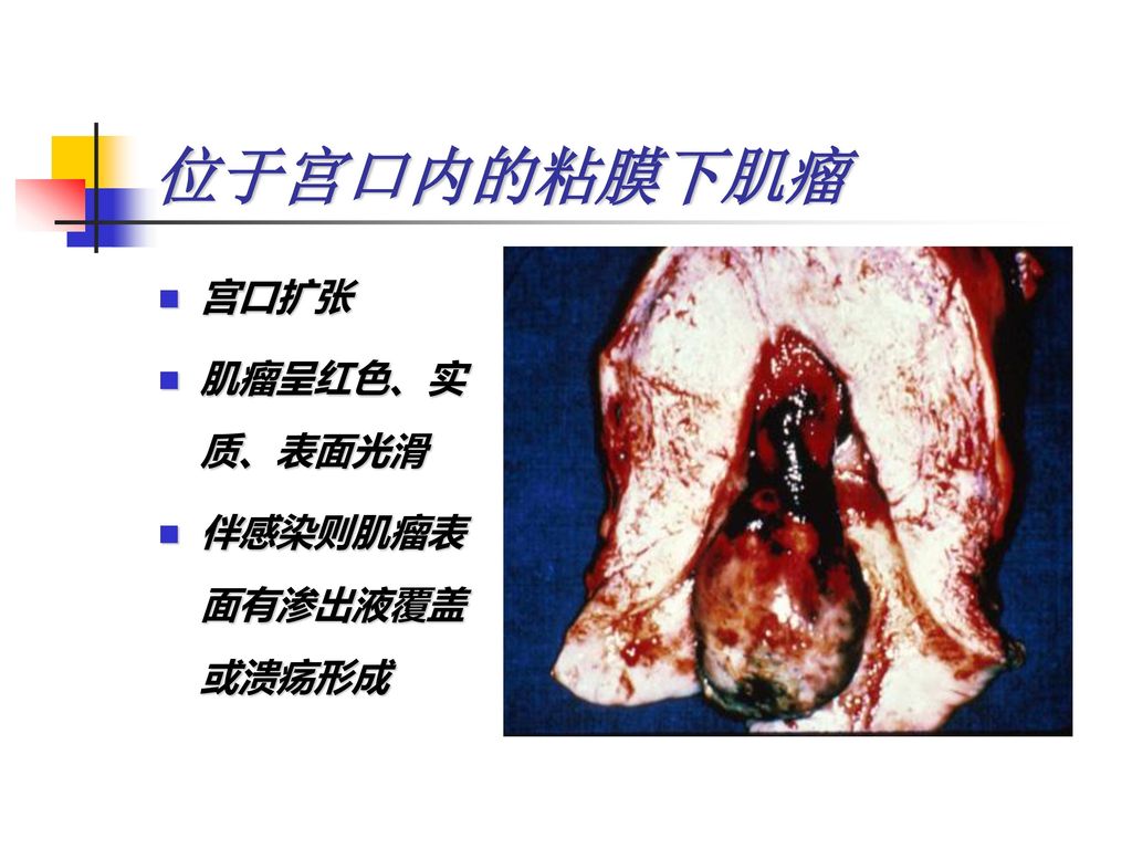 位于宫口内的粘膜下肌瘤 宫口扩张 肌瘤呈红色、实质、表面光滑 伴感染则肌瘤表面有渗出液覆盖或溃疡形成