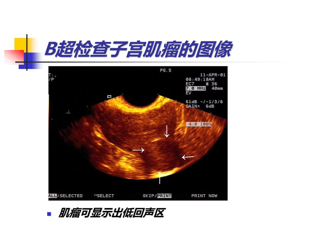 B超检查子宫肌瘤的图像 ↑ ↑ ↑ ↑ 肌瘤可显示出低回声区