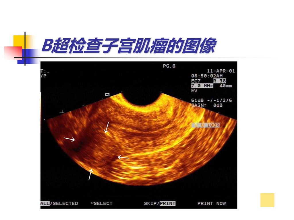 B超检查子宫肌瘤的图像 ↑ ↑ ↑ ↑