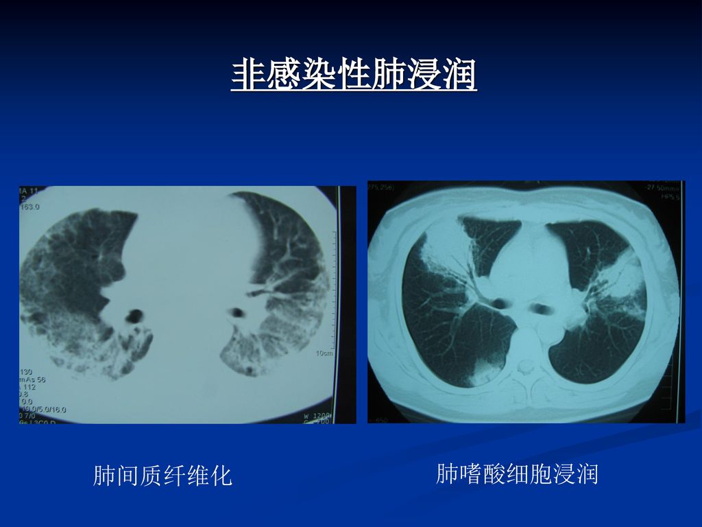 非感染性肺浸润 肺间质纤维化 肺嗜酸细胞浸润