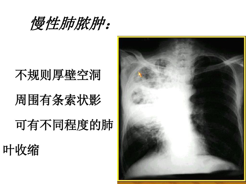 慢性肺脓肿： 不规则厚壁空洞 周围有条索状影 可有不同程度的肺 叶收缩