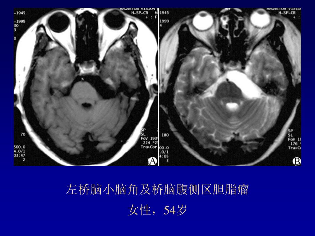 左桥脑小脑角及桥脑腹侧区胆脂瘤 女性，54岁