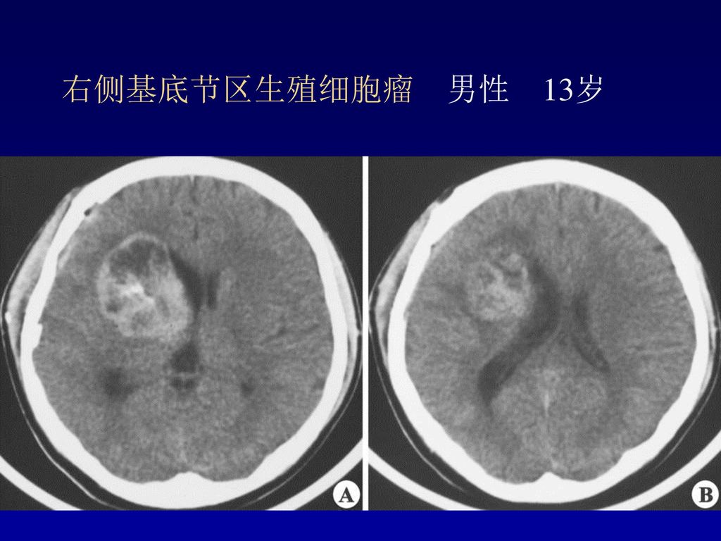 右侧基底节区生殖细胞瘤 男性 13岁