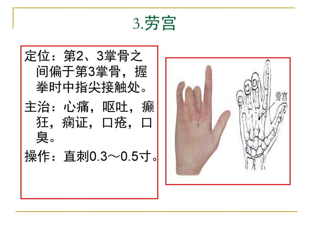3.劳宫 定位：第2、3掌骨之间偏于第3掌骨，握拳时中指尖接触处。 主治：心痛，呕吐，癫狂，痫证，口疮，口臭。 操作：直刺0.3～0.5寸。