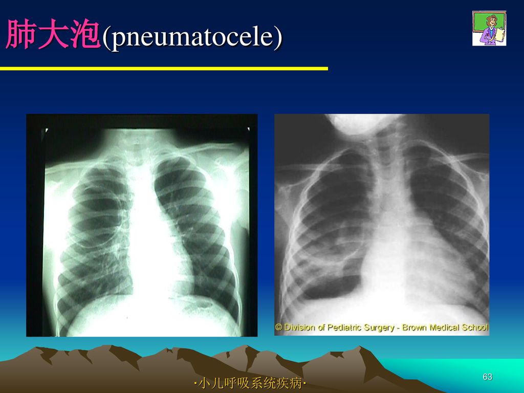 肺大泡(pneumatocele) ·小儿呼吸系统疾病·