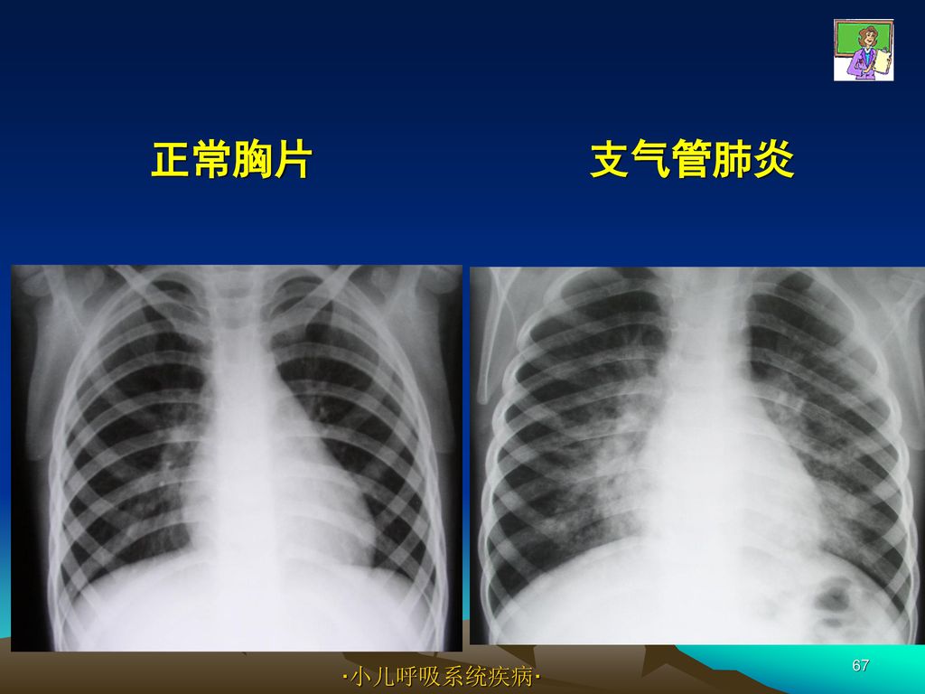 正常胸片 支气管肺炎 ·小儿呼吸系统疾病·