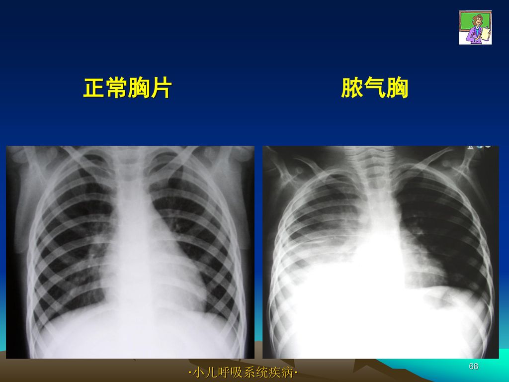 正常胸片 脓气胸 ·小儿呼吸系统疾病·