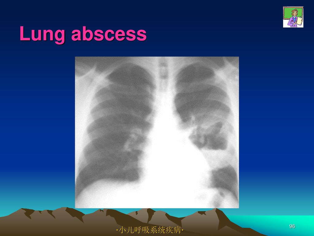 Lung abscess ·小儿呼吸系统疾病·