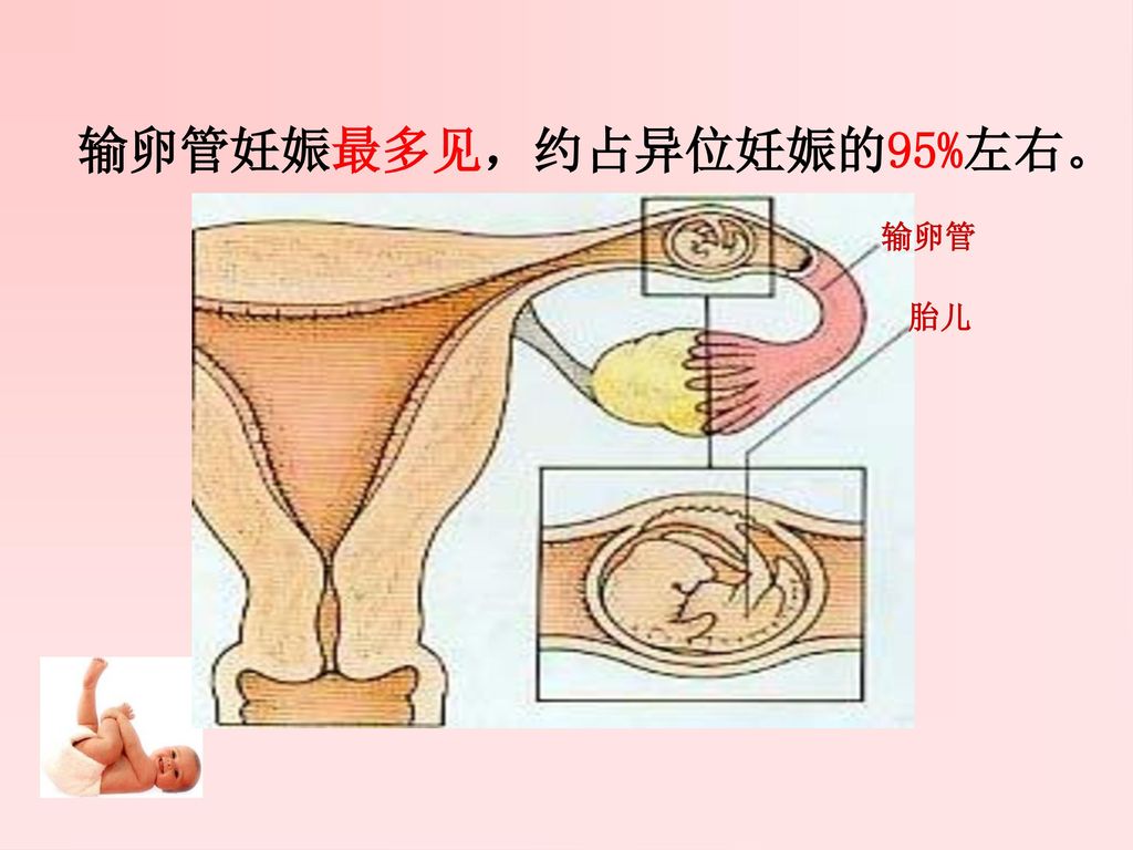 输卵管妊娠最多见，约占异位妊娠的95%左右。