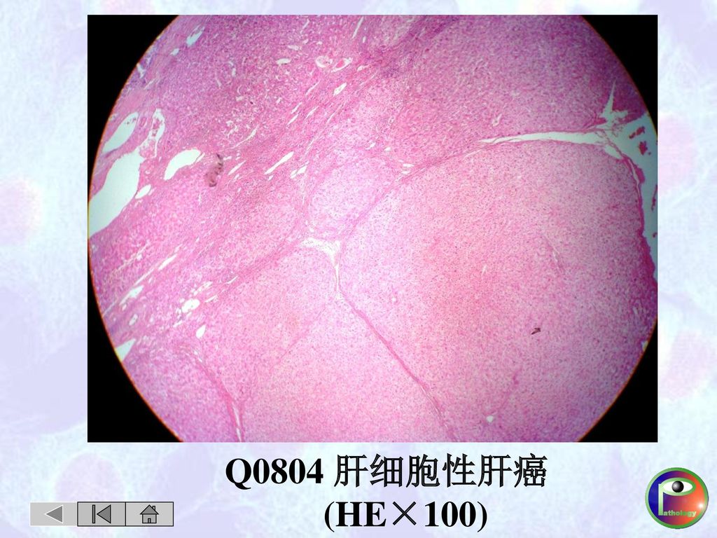Q0804 肝细胞性肝癌 (HE×100)