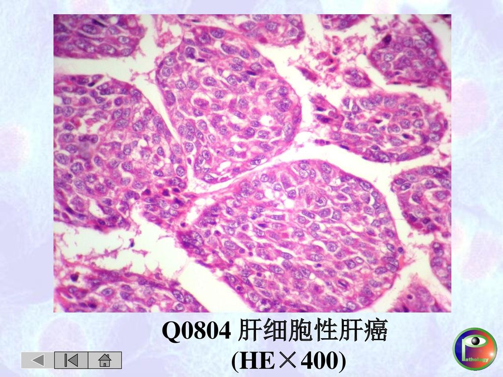 Q0804 肝细胞性肝癌 (HE×400)