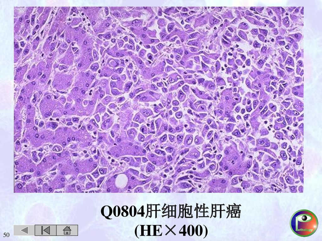 Q0804肝细胞性肝癌(HE×400) 50
