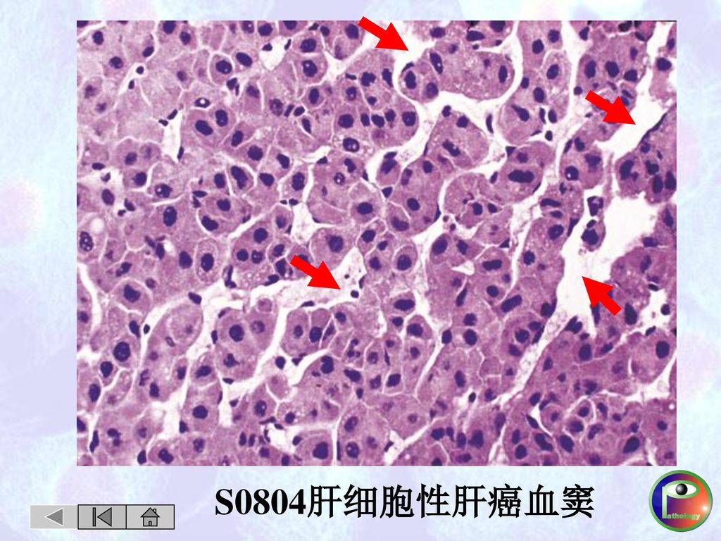 S0804肝细胞性肝癌血窦