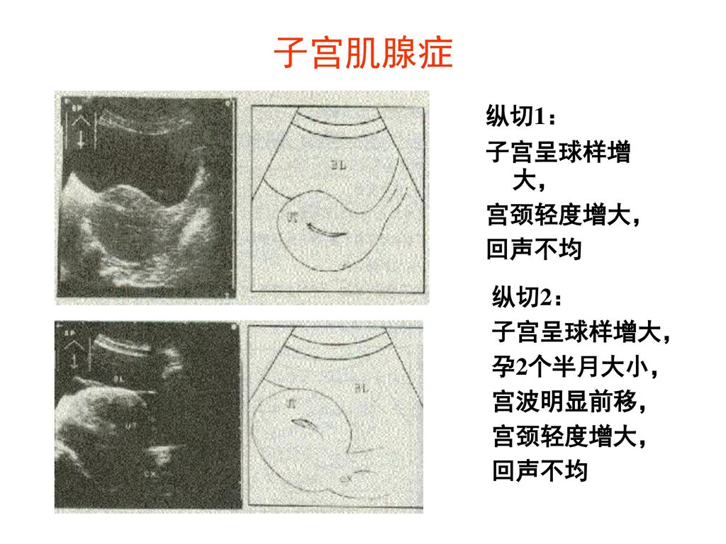 子宫肌腺症 纵切1： 子宫呈球样增大， 宫颈轻度增大， 回声不均