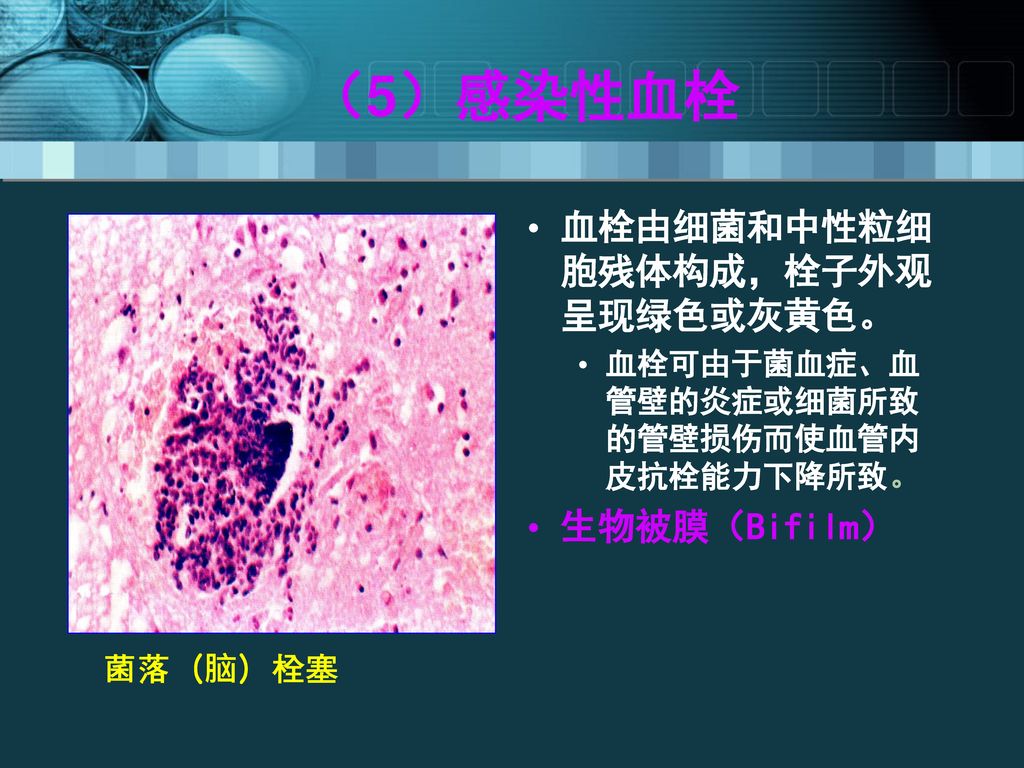 （5）感染性血栓 血栓由细菌和中性粒细胞残体构成，栓子外观呈现绿色或灰黄色。 生物被膜（Bifilm） 菌落（脑）栓塞