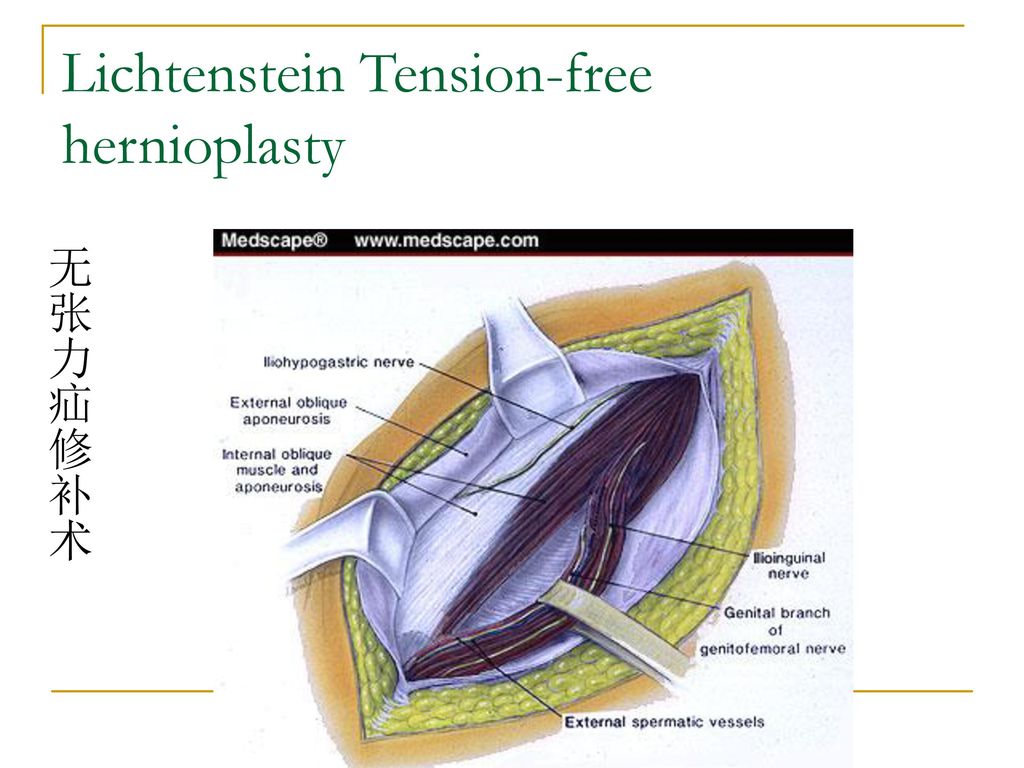 Lichtenstein Tension-free hernioplasty