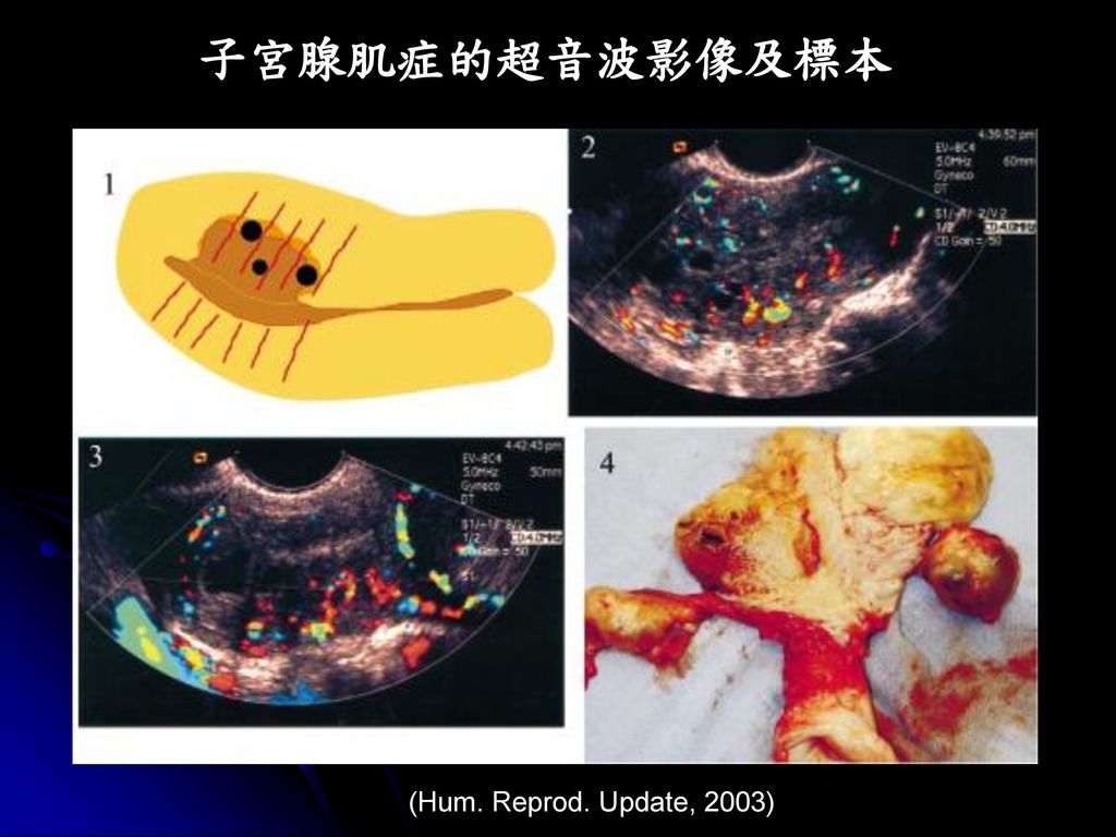 子宮腺肌症的超音波影像及標本 (Hum. Reprod. Update, 2003)