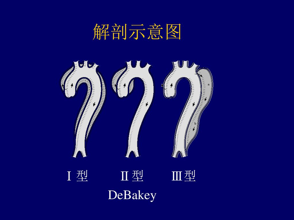 解剖示意图 Ⅰ型 Ⅱ型 Ⅲ型 DeBakey