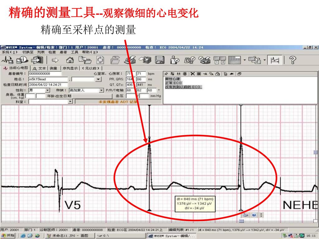 精确的测量工具--观察微细的心电变化 精确至采样点的测量