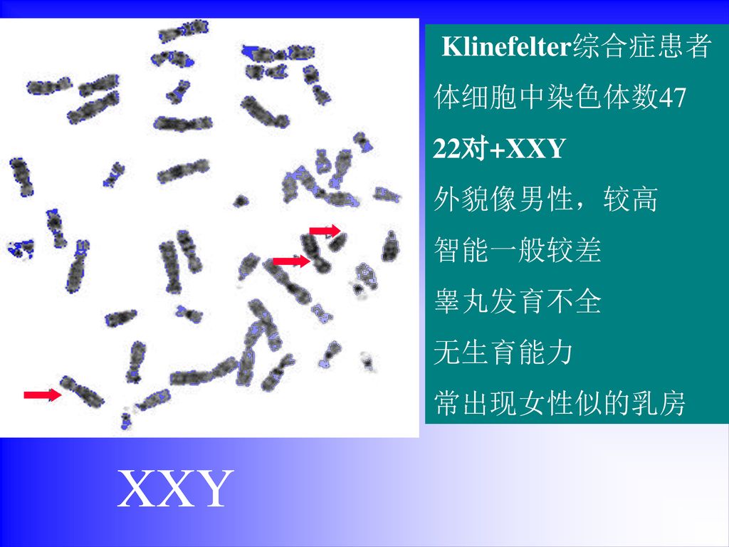 XXY Klinefelter综合症患者 体细胞中染色体数47 22对+XXY 外貌像男性，较高 智能一般较差 睾丸发育不全 无生育能力