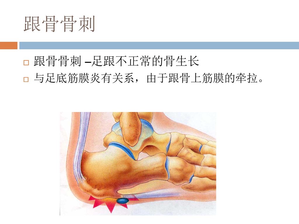 跟骨骨刺 跟骨骨刺 –足跟不正常的骨生长 与足底筋膜炎有关系，由于跟骨上筋膜的牵拉。