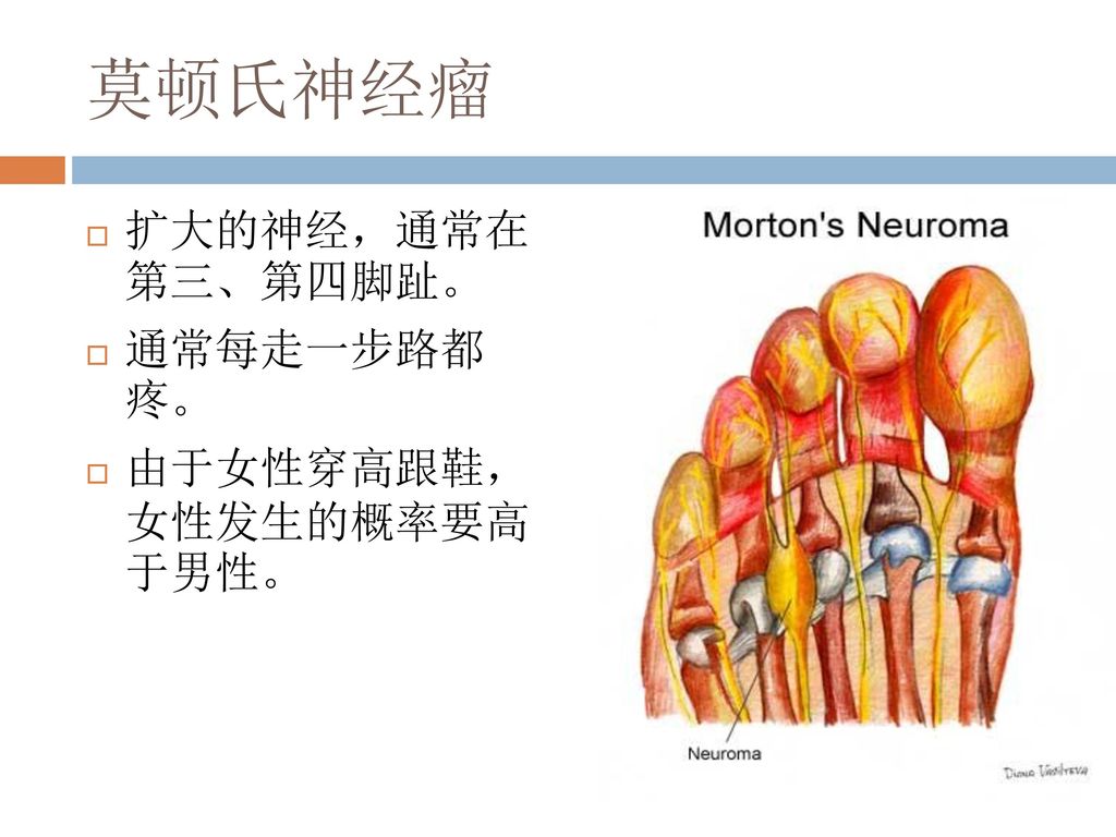 莫顿氏神经瘤 扩大的神经，通常在 第三、第四脚趾。 通常每走一步路都 疼。 由于女性穿高跟鞋， 女性发生的概率要高 于男性。