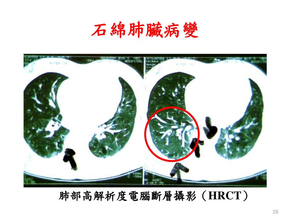 石綿肺臟病變 肺部高解析度電腦斷層攝影（HRCT）
