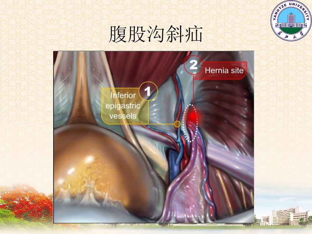 腹外疝abdominalhernia长江大学临床医学院外科教研室
