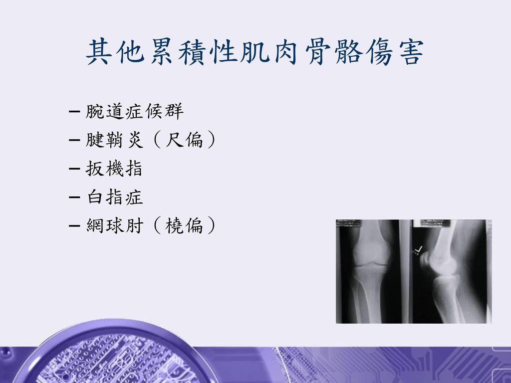 其他累積性肌肉骨骼傷害 腕道症候群 腱鞘炎（尺偏） 扳機指 白指症 網球肘（橈偏）