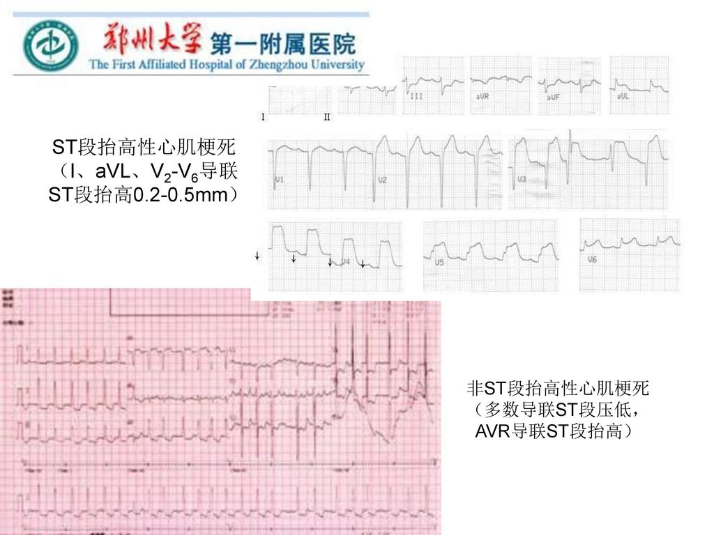 ST段抬高性心肌梗死（I、aVL、V2-V6导联ST段抬高 mm）