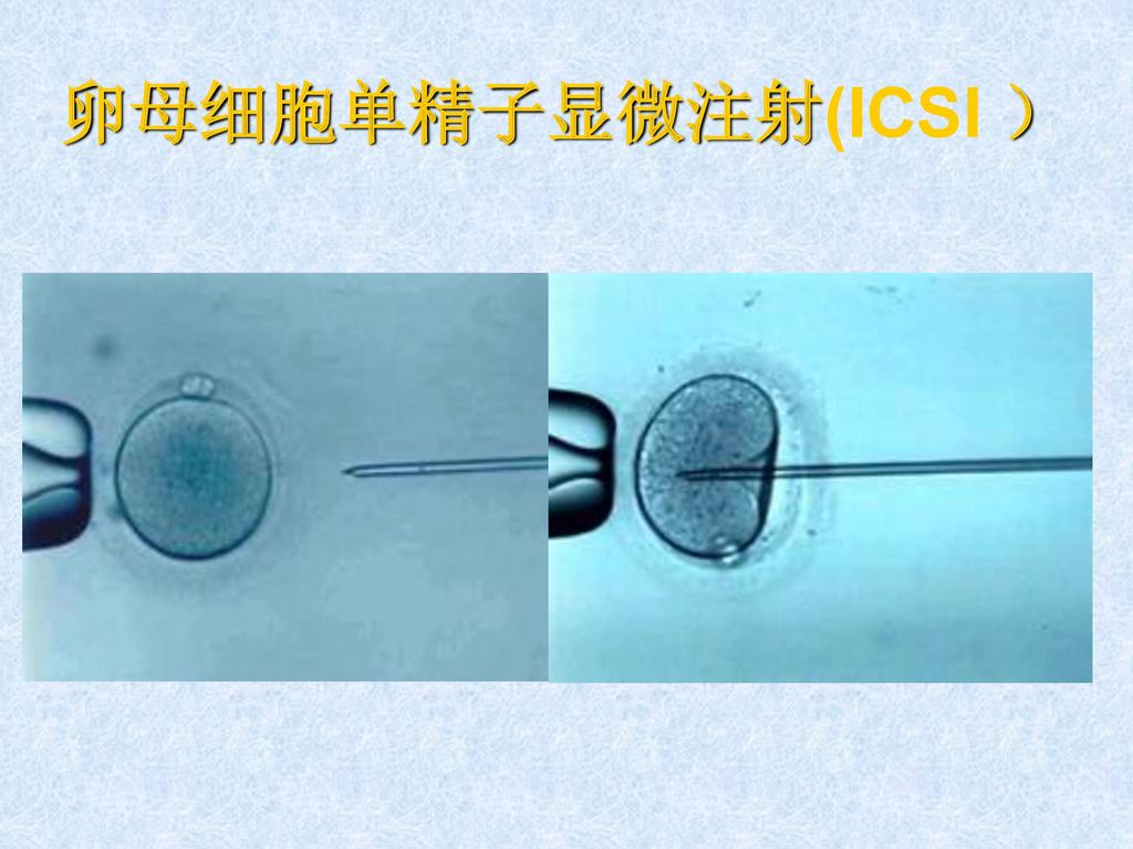 卵母细胞单精子显微注射(ICSI ）