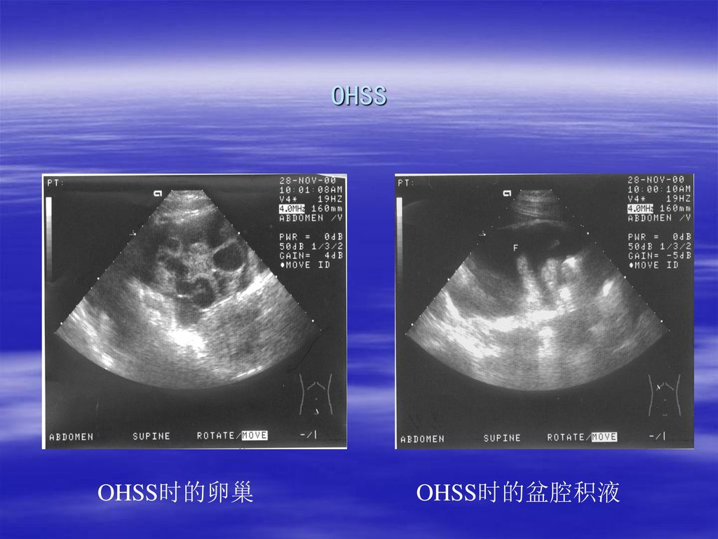 OHSS OHSS时的卵巢 OHSS时的盆腔积液