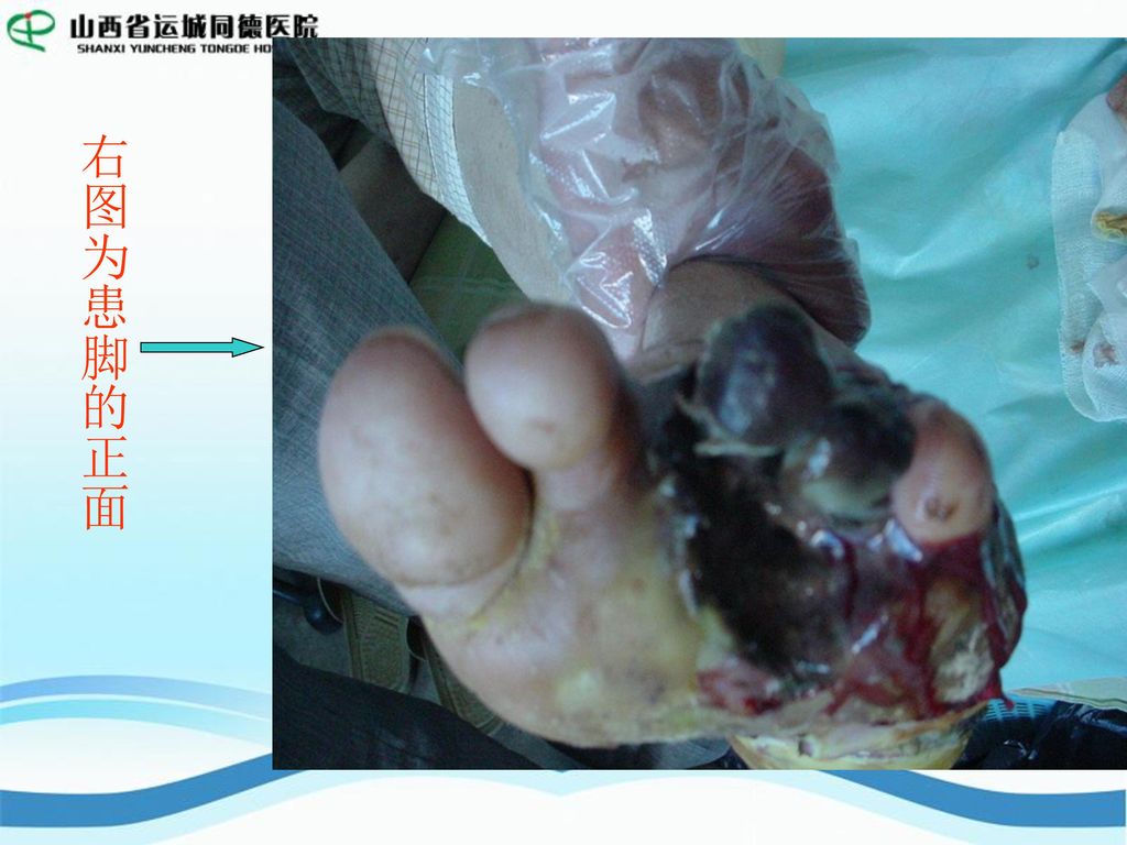 右图为该患者刚入院时 病脚的照片