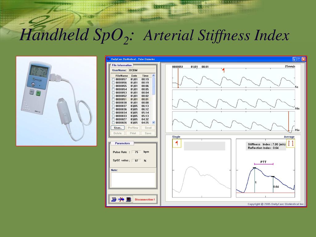 Handheld SpO2: Arterial Stiffness Index