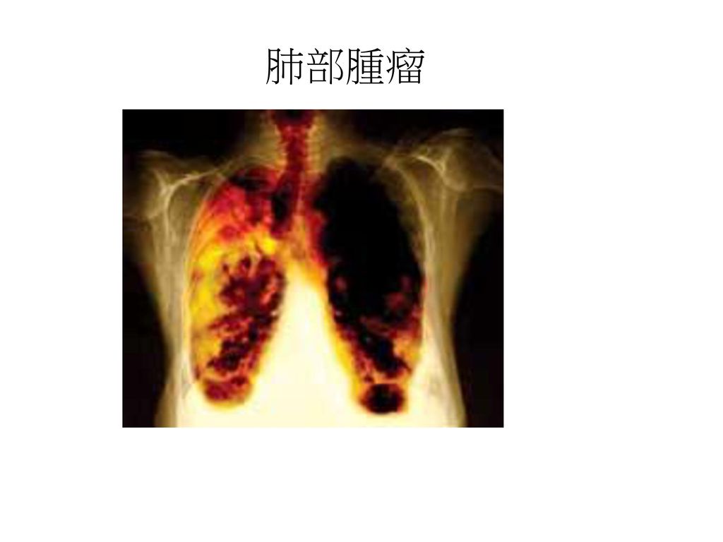 肺部腫瘤