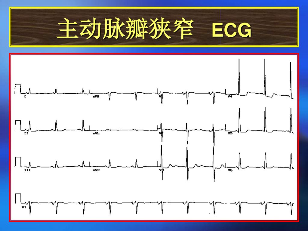主动脉瓣狭窄 ECG