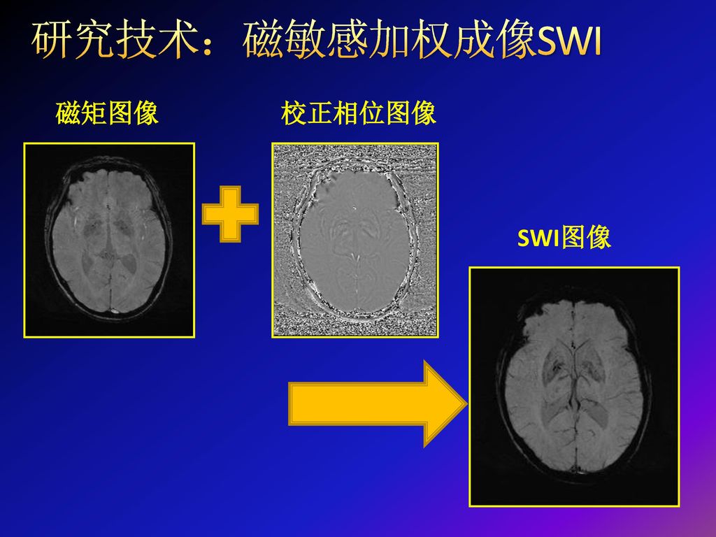 研究技术：磁敏感加权成像SWI 磁矩图像 校正相位图像 SWI图像