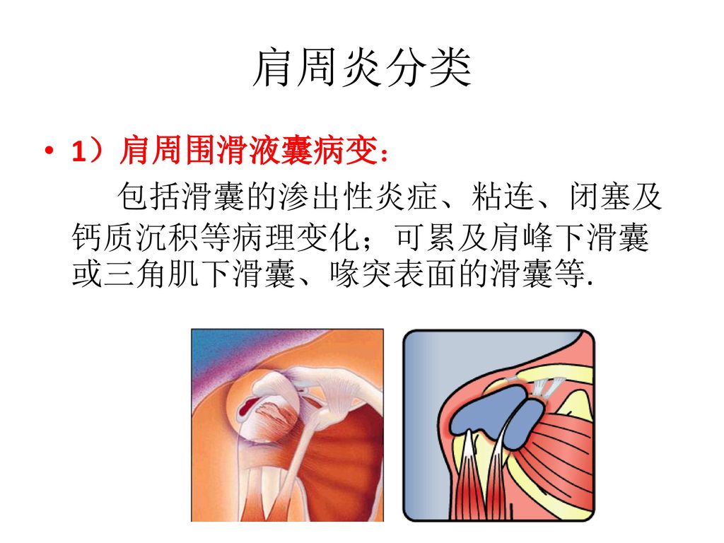 肩周炎分类 1）肩周围滑液囊病变： 包括滑囊的渗出性炎症、粘连、闭塞及钙质沉积等病理变化；可累及肩峰下滑囊或三角肌下滑囊、喙突表面的滑囊等.