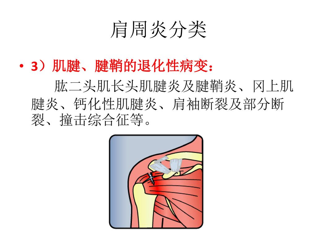 肩周炎分类 3）肌腱、腱鞘的退化性病变： 肱二头肌长头肌腱炎及腱鞘炎、冈上肌腱炎、钙化性肌腱炎、肩袖断裂及部分断裂、撞击综合征等。