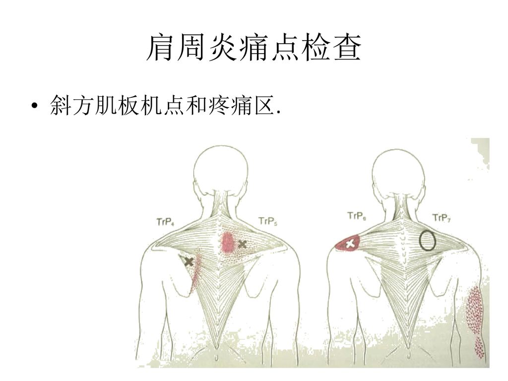 肩周炎痛点检查 斜方肌板机点和疼痛区.