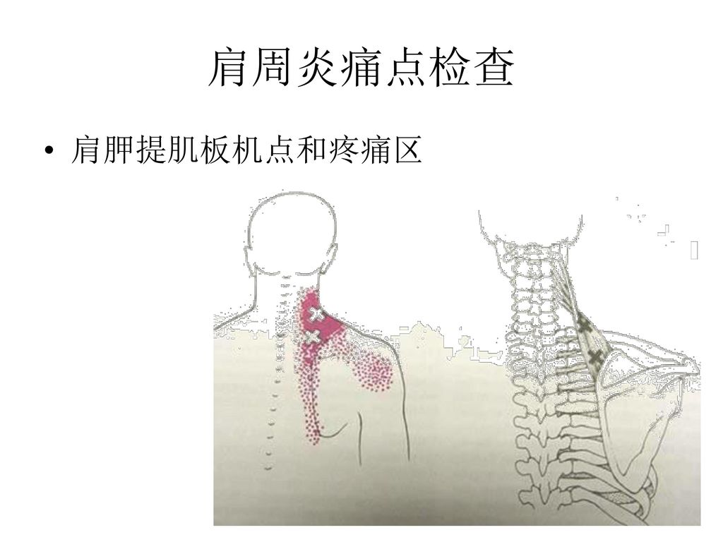 肩周炎痛点检查 肩胛提肌板机点和疼痛区