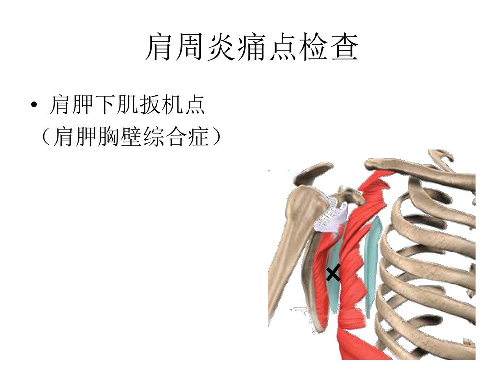 肩周炎痛点检查 肩胛下肌扳机点 （肩胛胸壁综合症）